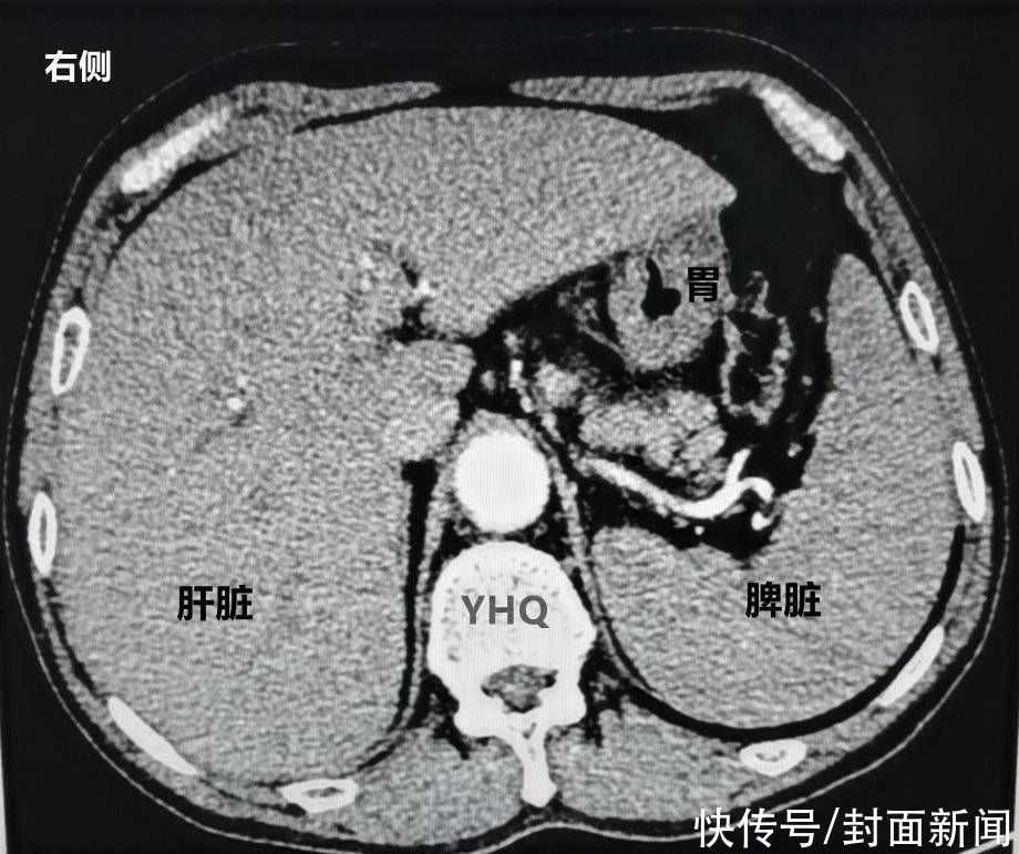 封面新闻|急诊遇上罕见“镜像人”成都专家“逆行”为其手术