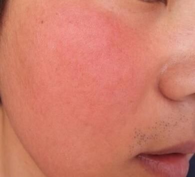  忽视|高血压会引起身体出现这些表现, 当你发现时别忽视!