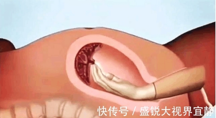 胎盘|生孩子后胎盘是怎样下来的, 看过这组动图你就明白了!
