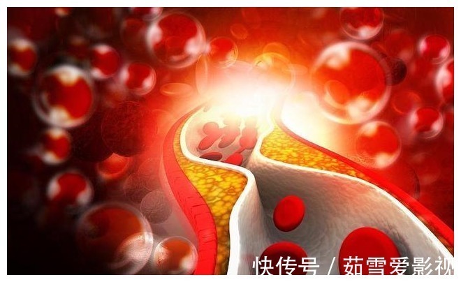 晴雨表|双腿或是血脂的“晴雨表”?腿上出现这3种现象,血脂可能偏高了