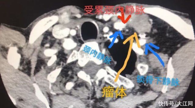 南大二附院|南大二附院多学科协作成功完成一例复杂甲状腺癌全切除术