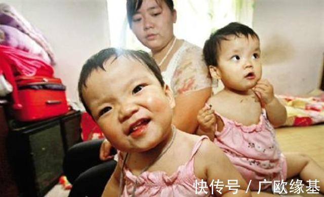 双胞胎|我国首例“坐骨连体”双胞胎,成功分开11年了,她们现在还好吗