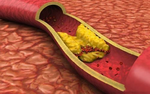 降低|甘油三酯和胆固醇都是高血脂，有什么区别如何降低