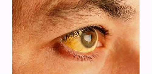 黄曲霉毒素|肝癌的高危人群有哪些?肝功能异常,或有9个征兆,别当成小问题