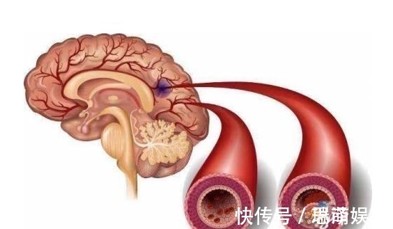 血脂|血脂高的人，多观察手指，若没这几个异常，说明脑梗离你还很远