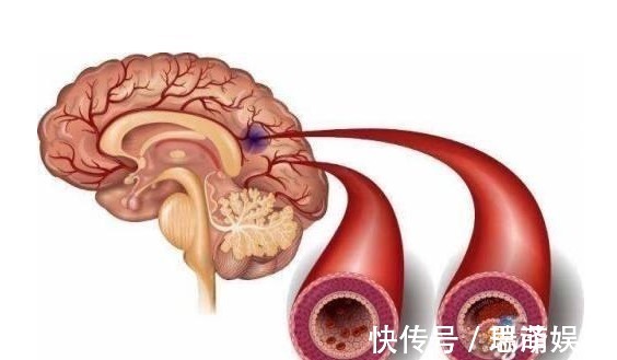 血脂|血脂高的人,多观察手指,若没这几个异常,说明脑梗离你还很远