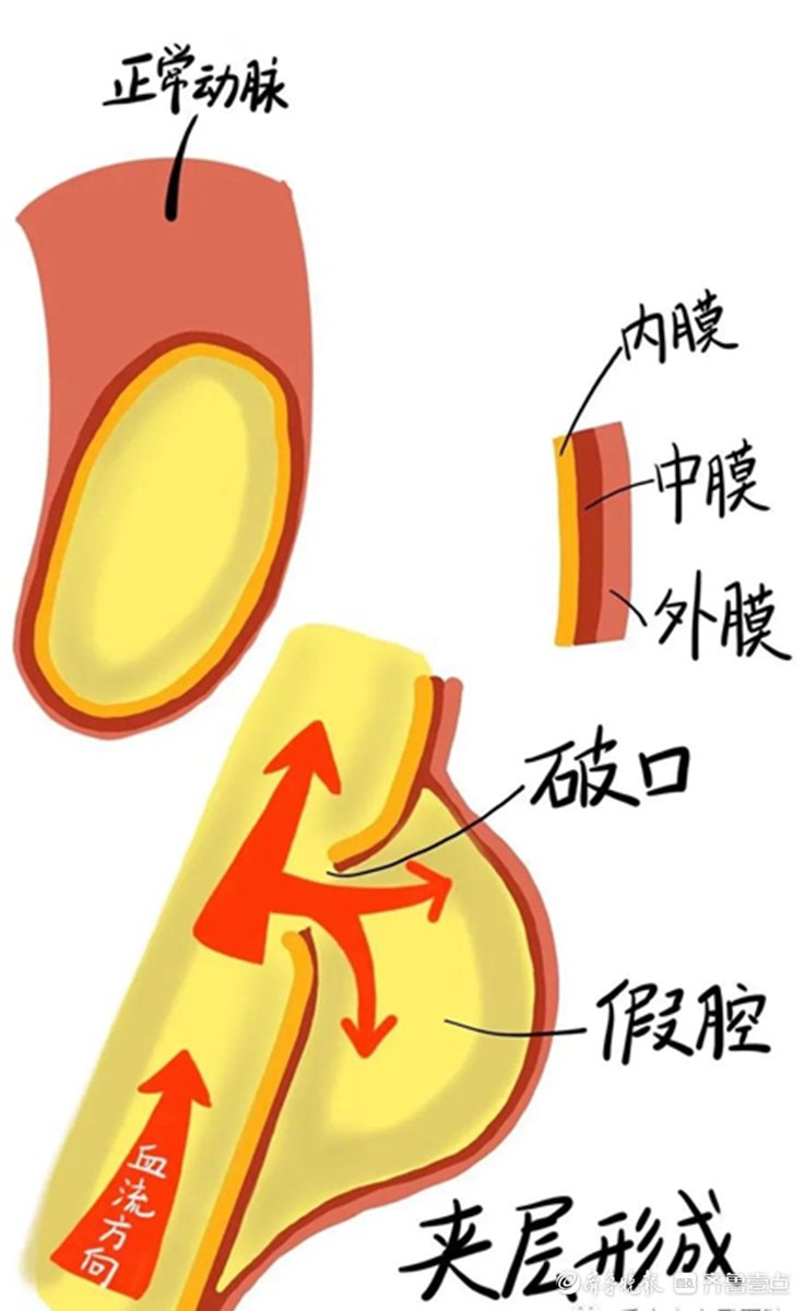 历经10个多小时，他们为患者拆除了“血管炸弹”