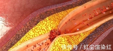 暴躁症|女司机保温杯里泡枸杞,化疗2次肝癌逝世,医生:肝脏已“千疮百孔”