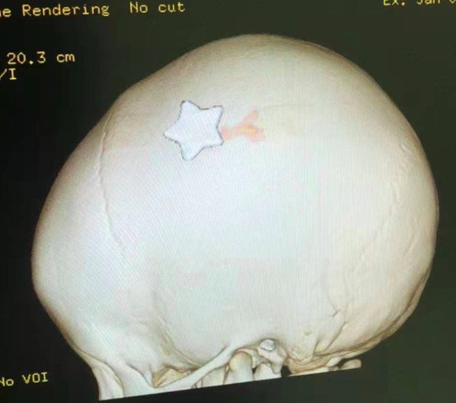 凹陷性骨折|3岁女童一跤摔进ICU,撞碎颅骨、刺破脑膜