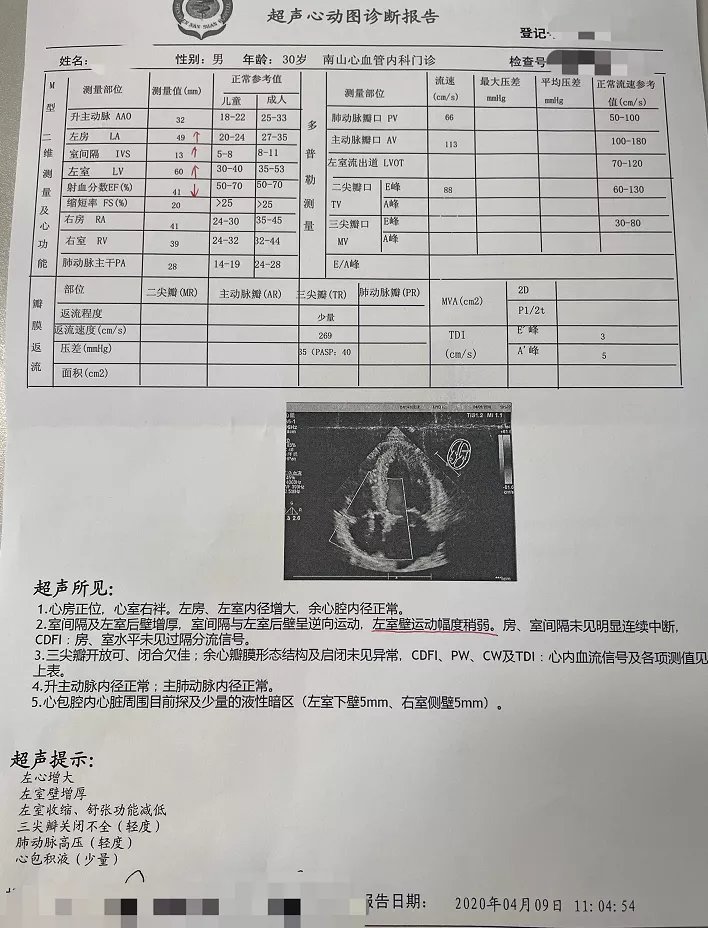 原发性高血压|30岁男子高血压致急性心衰，停药半年心脏“膨胀”一倍