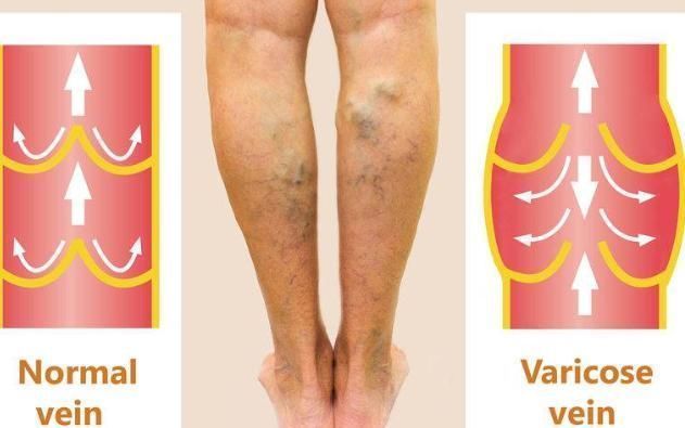 高发|4种人易被血栓“拴住”，医生：教你三招让血管不赌，冲走血栓