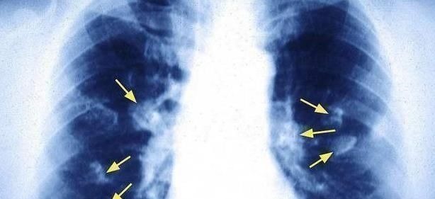 疼痛|肺癌一发现都是晚期错早期往往有蛛丝马迹,是身体在向你求救
