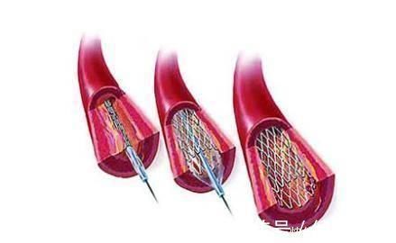 卵磷脂|脑梗的“祸根”终于揪出这5个习惯再不改，血栓很容易一堵再堵