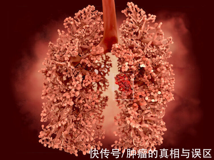 防治|发病率、死亡率第一！肺癌的2个防治关键，做好了或能提高生存率