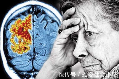 神经突触|最近爆火的老年痴呆测试图，花一分钟来测一测，不花钱买个放心