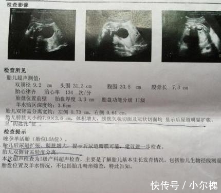五个字|B超单上若有这五个字, 孕妈就乐吧, 可能是“小淘气”来敲门了