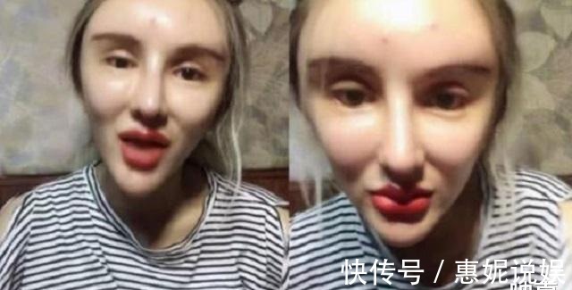 奥美定|“粉红宝宝”:为了美13年整形200多次,如今只能坐在轮椅上