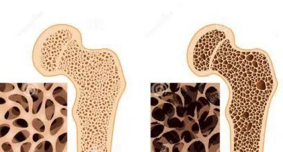 骨密度|骨质疏松别老想着吃钙片，牢记“几个原则”，骨密度慢慢上涨