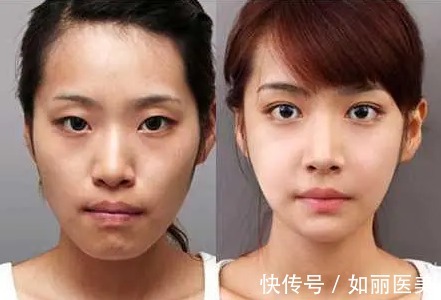 实情 双眼皮手术整形的“实情”,医生也许并不会告诉大家的