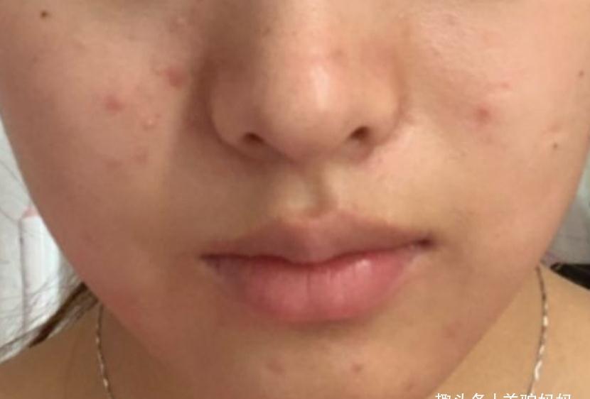 妇科病|女性子宫好不好看“脸”便知，若脸上没这些漏洞，说明子宫很干净