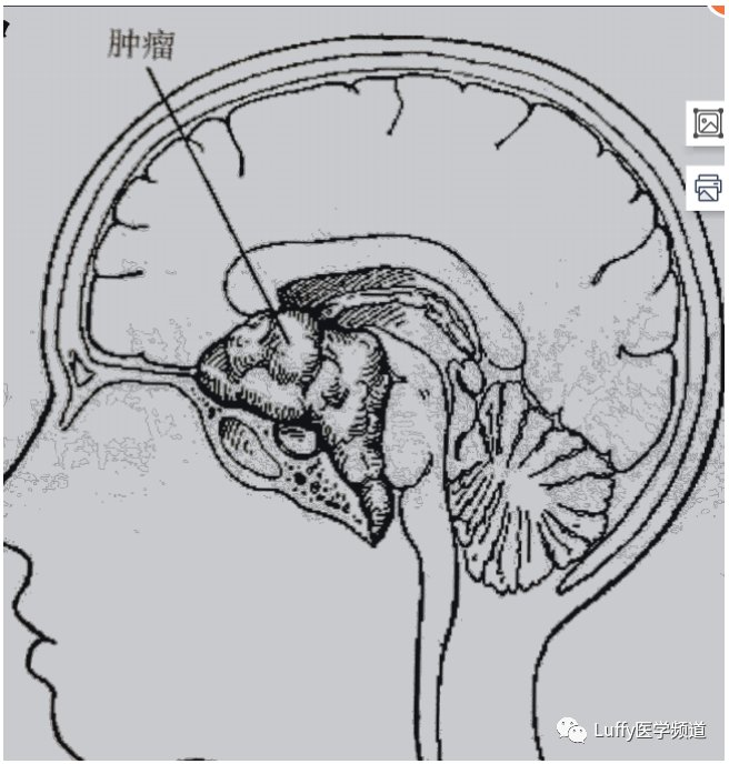 血糖监测|【小儿麻醉】颅咽管瘤的麻醉管理