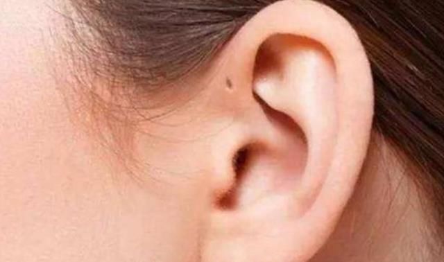 家长|为什么有的新生儿耳朵有“小孔”?医生一般不说,家长心中要有数