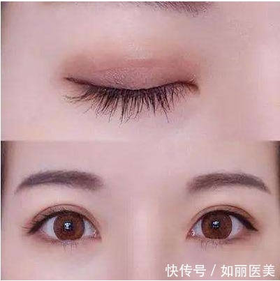 眼部 全切双眼皮多久能恢复正常?术后效果怎么样?快来看看吧