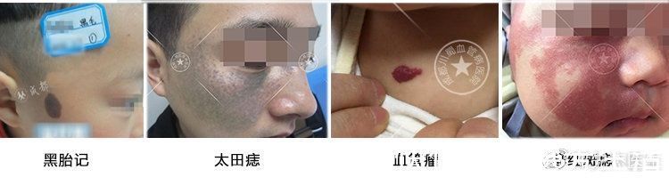 化妆品|准妈妈们看过来 ! 预防新生儿胎记,需要注意这几点 !