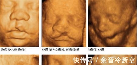 患儿|孕6月检查发现孩子唇腭裂三级, 这些伤害胎儿的行为孕妈不要再做了！