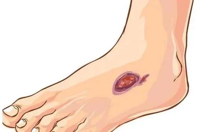 胰岛素抵抗|血糖高不高，只需看身体的4个地方就知道！降血糖用3招