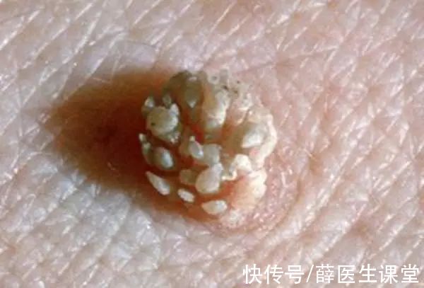 女大学生|95后女大学生一寝室4人，相继查出HPV，医生提醒：3个地方少去