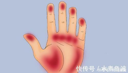 黄疸症|肝脏逐渐变好时,身体有3处会慢慢变色,多占一个也值得恭喜