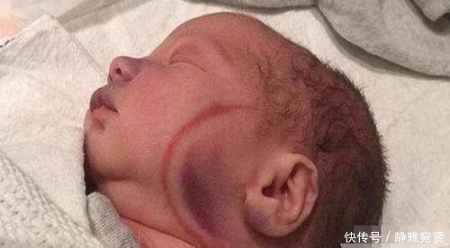 产妇|高龄产妇不听劝硬要生娃,顺产时医生被迫用产钳,女儿被毁容