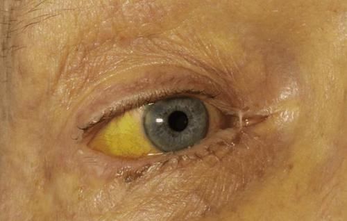 凝血因子|天然的“养肝王”找到了,不是枸杞和大蒜,你若爱吃,肝日益变好