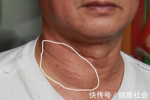 脖子|癌症早期有什么症状?如何才能早发现?