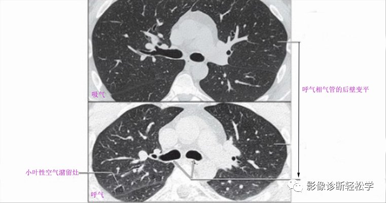 呼气相|肺部HRCT读片基础之四： 气道和肺马赛克灌注