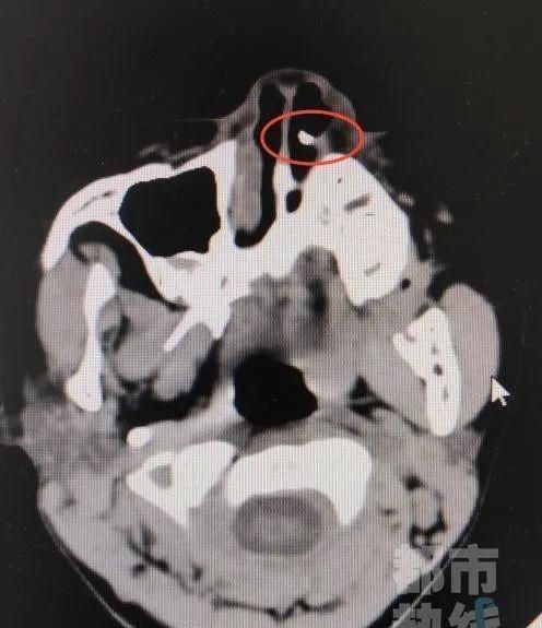 失踪|一6岁女童鼻子里“长牙”,取出后发现竟是三年前失踪的门牙