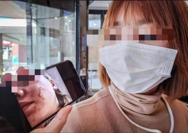 女子花近3万整容换回二度烫伤，医美医院：正常不良反应