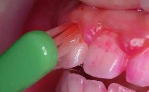 肝脏|李兰娟研究肝病50年，总结出3条“经验”，肝不好的人，建议收藏