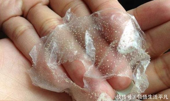 鼻子上挤出来的白色物体是什么皮肤科医生给出这些忠告