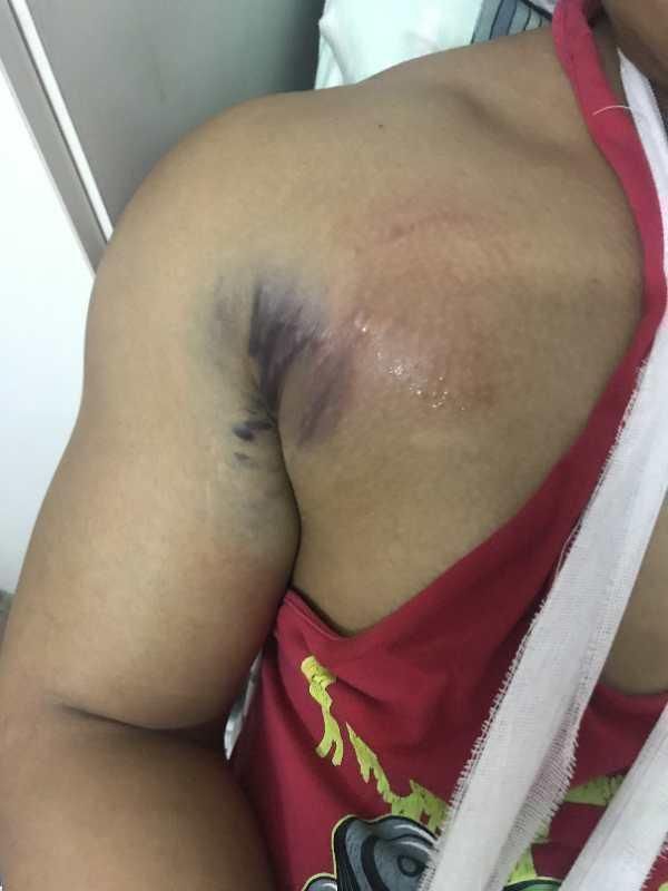 李劼若|健身教练卧举380斤失败胸大肌被生生撕脱