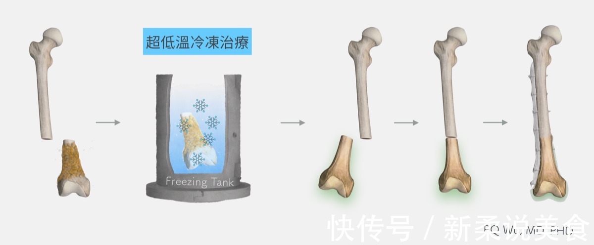 细胞|注射一针疫苗,就能杀死身上所有癌细胞,这种理想离实现有多远