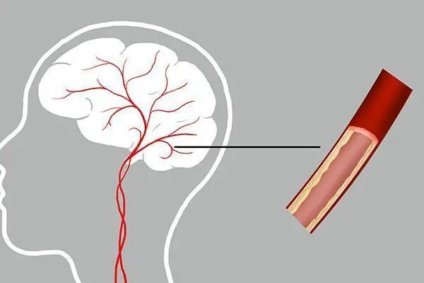 脑供血不足|脑供血不足 会向身体发出哪些“指示”？