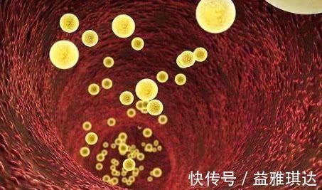 心脑血管|高血脂只能靠吃药 常吃这几种天然食物, 血脂或许悄悄降下来