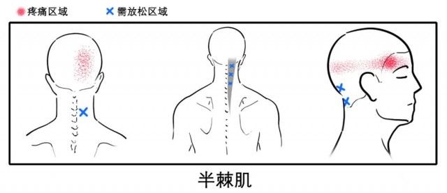 颈椎|八成头痛和颈椎有关！一份“疼痛位置图解”帮你对症放松