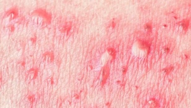  方说|艾滋病的临床表现有哪些？医生：此些不起眼的表现值得关注！