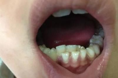 男孩|4岁男孩长出双排牙,只因父母太过“细养”孩子,医生太无知