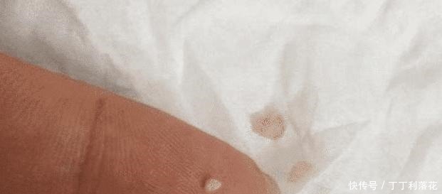 嘴角的下巴总是有白色的痘痘,且还连成一片,是螨虫吗