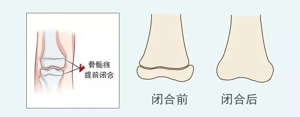 第二性征|别让性早熟耽误了孩子长高！北斗星儿童医院提醒家长留意!