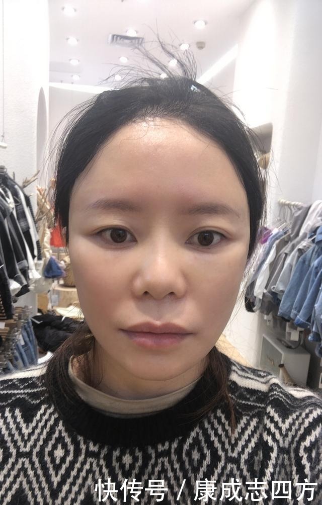 求美者|小拉皮术后1个月,总结几点我的体验感受